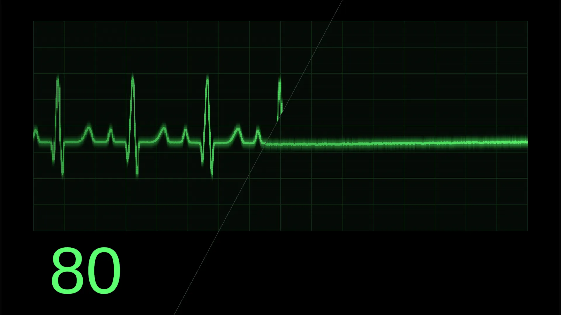 A trace running down to a flatline
